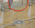 Stainless steel fissure drainage channel 1